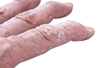 Psoriasis, skin disease on the joints of the body