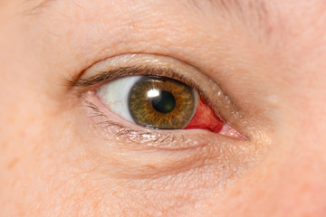 Fototapeta premium Subconjunctival hemorrhage - hyposphagma. Closeup of woman's red bloodshot eye looking right