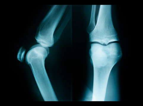 X-ray picture showing knee joints.