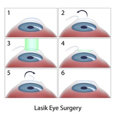 Lasik eye surgery procedure - obrazy, fototapety, plakaty