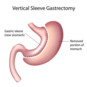 Vertical Sleeve Gastrectomy (VSG), labeled. 