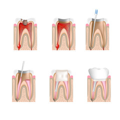 Root canal treatment, non-labeled