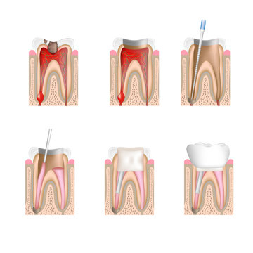 Root Canal Treatment, Non-labeled