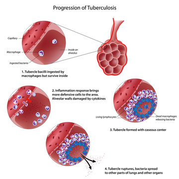Progression of pulmonary tuberculosis