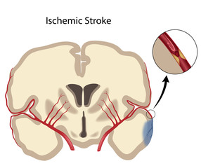 Brain ischemic stroke