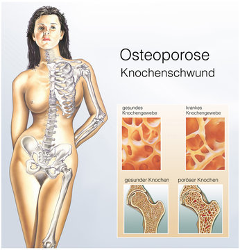 Knochenschwund, Osteoporose