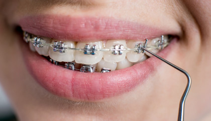 Close-up shot of teeth with braces. Smiling female patient with metal brackets at the dental...