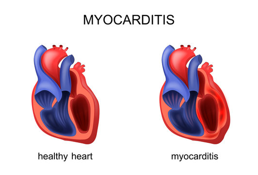 Heart Healthy And Diseased Myocarditis