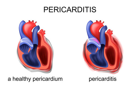 a healthy pericardium, pericarditis