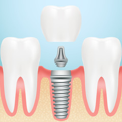 Realistic Healthy Teeth And Dental Implant. Installation Of Dental Implant With All Parts Crown, Abutment, Screw Isolated On A Background. Vector Illustration. Stomatology. Creative Medical Concept