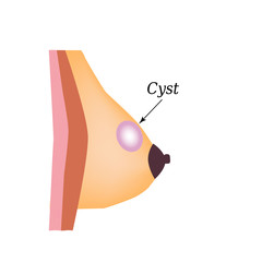Cyst in the mammary gland. World Breast Cancer Day. Vector illustration on isolated background