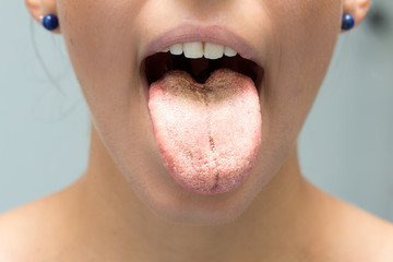 Candida albicans infection on tongue of woman