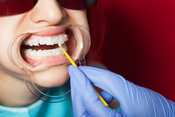 Close-up of a dentist with the help of special equipment whitening  the teeth of a young  woman in red goggles with a tooth holder to an ideally white color on a red design chair - obrazy, fototapety, plakaty