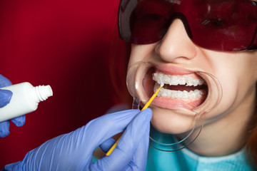 Close-up of a dentist with the help of special equipment whitening  the teeth of a young  woman in red goggles with a tooth holder to an ideally white color on a red design chair - obrazy, fototapety, plakaty