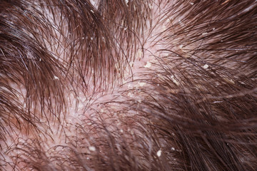 Dandruff on male dark hair