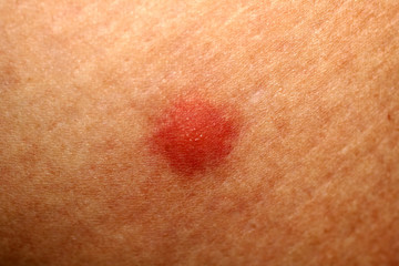 Fototapeta premium 1238137 Red mosquito bites. Swelling of the skin. A bite of a wasp, a bee.