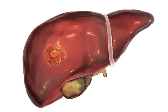 Liver cancer. 3D illustration showing presence of tumor inside liver
