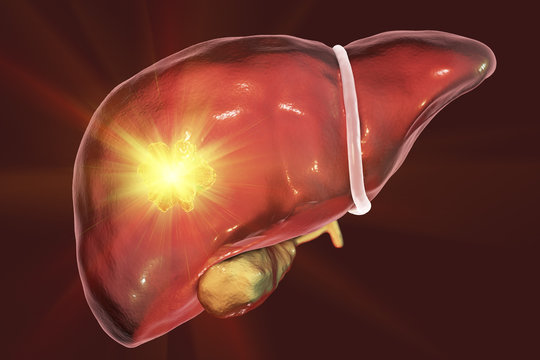 Liver Cancer Treatment. Conceptual Image. 3D Illustration