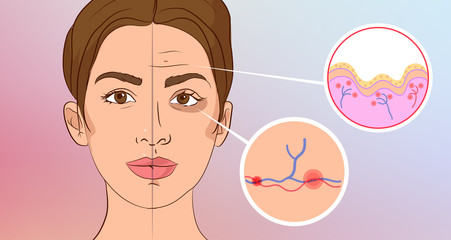 Premature wrinkles. Cosmetology. Aging of the skin, bruises under the eyes