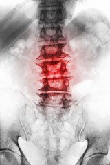 Spondylosis .  film x-ray lumbosacral spine of old aged patient show osteophyte , collapse spine...