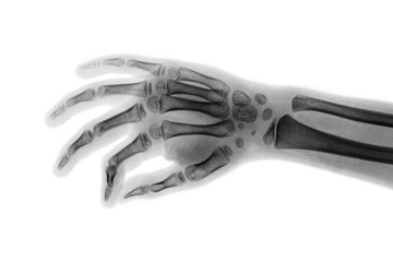 Film x-ray hand of child . Oblique view