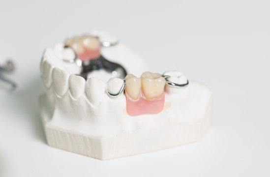 Zahnersatz im Prothesentr&auml;ger im Dentallabor
