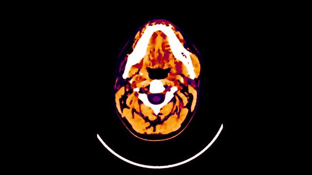 Magnetic Resonance Imaging of the Brain - CT Scan