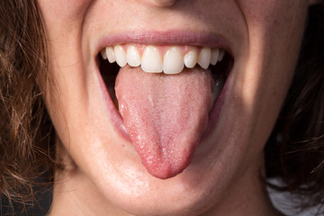 Girl on a check visit to detect candidiasis on tongue