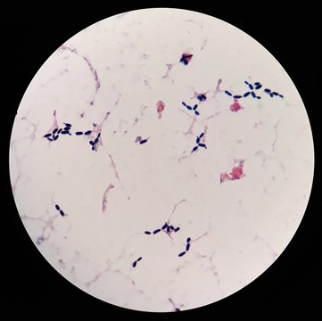 Smear of human blood cultured Gram's stained under 100X light microscope with many budding yeast (Selective focus).