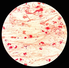 Smear of sputum specimen Gram's stained under 100X light microscope with many gram positive cocci bacteria (Selective focus).