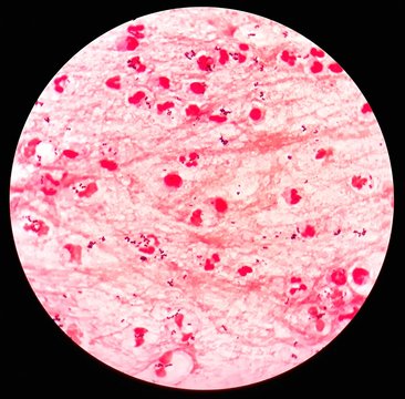 Smear of sputum specimen Gram's stained under 100X light microscope with many gram positive cocci bacteria (Selective focus).