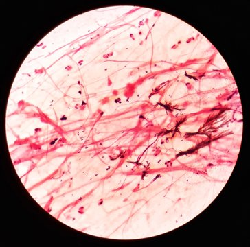 Smear of sputum specimen Gram's stained under 100X light microscope with moderate gram positive bacilli bacteria and few color sediment (Selective focus).