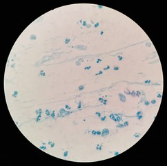 Poor smear staining quality of Acid-Fast bacilli (AFB) stained from sputum specimen with many white...