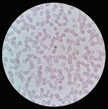Under 100X light microscope, human parasite on thin film of blood smear with Plasmodium malariae trophozoite form malaria infected red blood cell, selective focus.