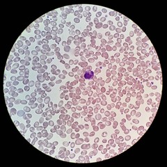 Human blood smear with abnormal red blood cells morphology call stomatocyte and white blood cell...
