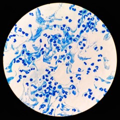 Smear of Acid-Fast bacilli (AFB) stained from sputum specimen with numerous white blood cells (WBC), under 100X light microscope.