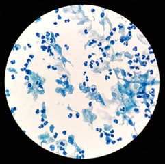 Smear of Acid-Fast bacilli (AFB) stained from sputum specimen with numerous white blood cells (WBC), under 100X light microscope.