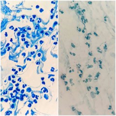 Two Acid-Fast bacilli (AFB) stained patterns from sputum smear with many white blood cells under 100X light microscope, good staining quality is on the left and poor staining quality is on the right.