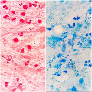 Two smear patterns of gram positive cocci bacteria in sputum specimen under 100X light microscope, from gram's stained is on the left and stained from Acid-Fast bacilli (AFB) is on the right.