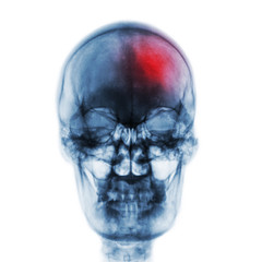Stroke ( Cerebrovascular accident ) . Film x-ray skull of human with red area . Front view