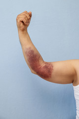 Man's hand with hematoma