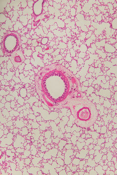 Lung bronchus