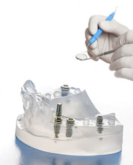 dental implants in dental model