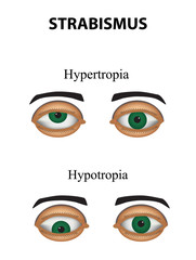 Strabismus. Hypertropia. Hypotropia. Infographics. Vector illustration on isolated background
