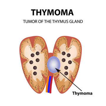 Tumor of the thymus gland. Thymoma. Infographics. Vector illustration on isolated background