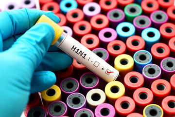 Obraz premium Blood sample positive with H1N1 influenza virus 