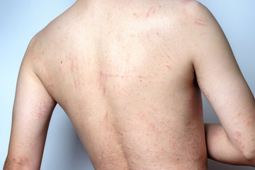 Fototapeta premium Man with dermatitis problem of rash