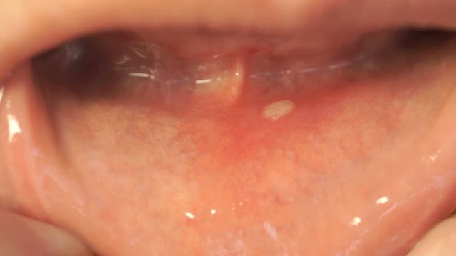 Disease in the mouth. Stomatitis into mouth on the lower lip. Close-up