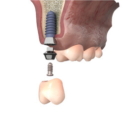 Dental anatomy - Higherdental implant with bone structure, teeth and gum section  © lightmachine
