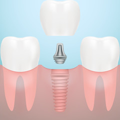 Human Teeth And Dental Implant Isolated On A Background. Vector Illustration. Stomatology. Creative Medical Concept